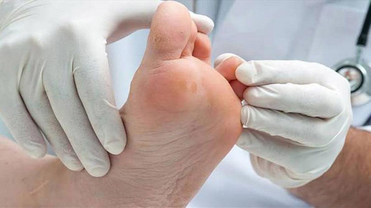 علت بروز زخم پا در افراد دیابتی چیست؟ علت بروز زخم پا در افراد دیابتی چیست؟