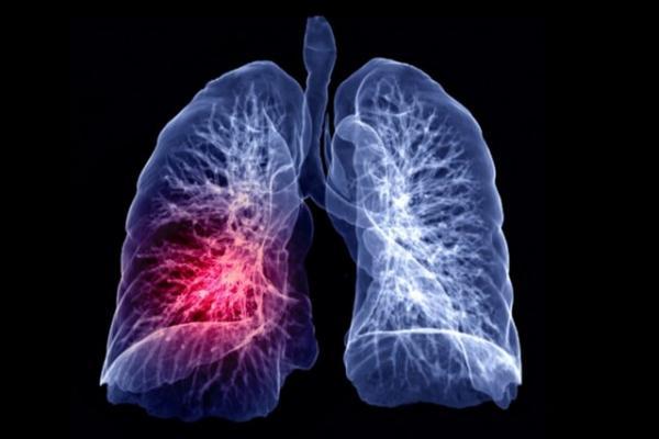 سلول های سرطان ریه، کبد را برای تامین سوخت خود به کار می گیرند!
